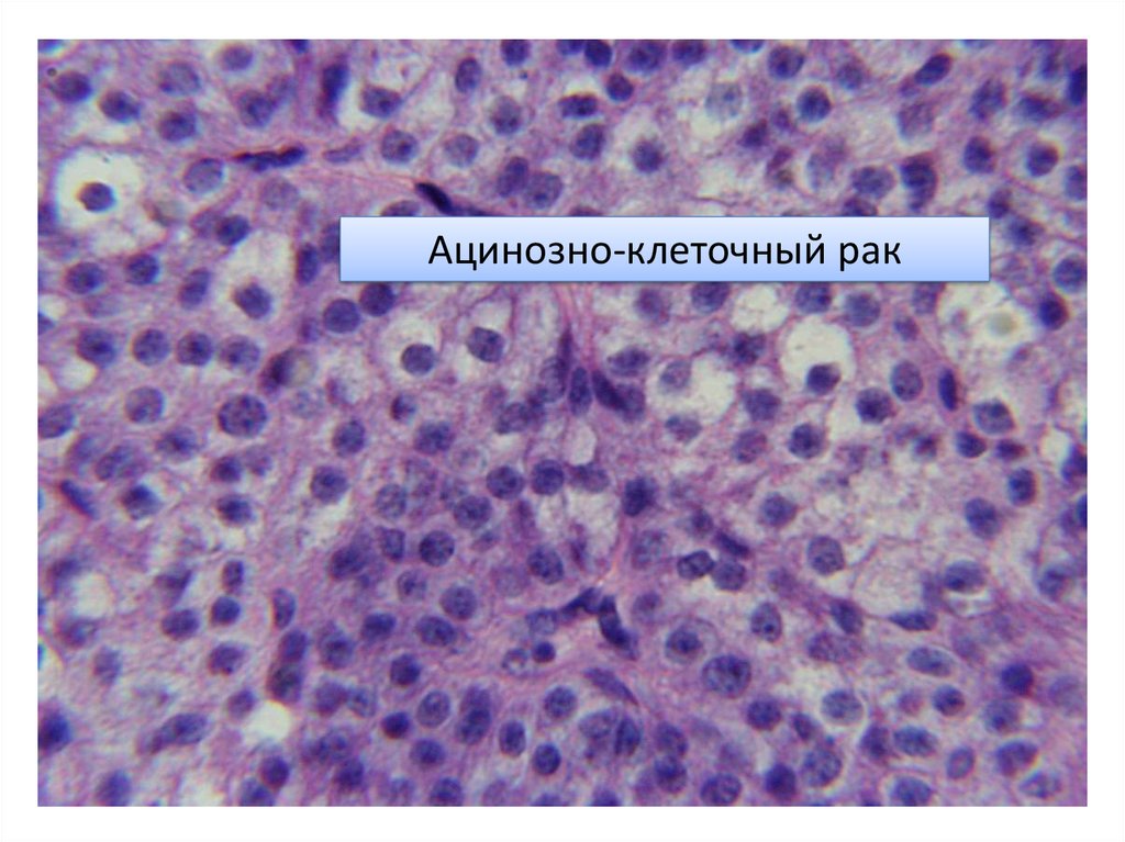 Клеточный рак. Ацинозноклеточная карцинома. Ацинозно-клеточная опухоль. Ациноклеточная опухоль слюнной железы.
