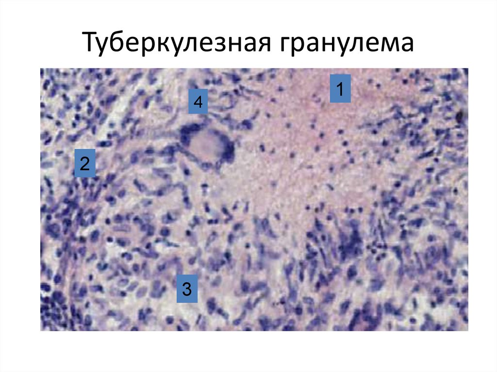 Туберкулезная гранулема рисунок