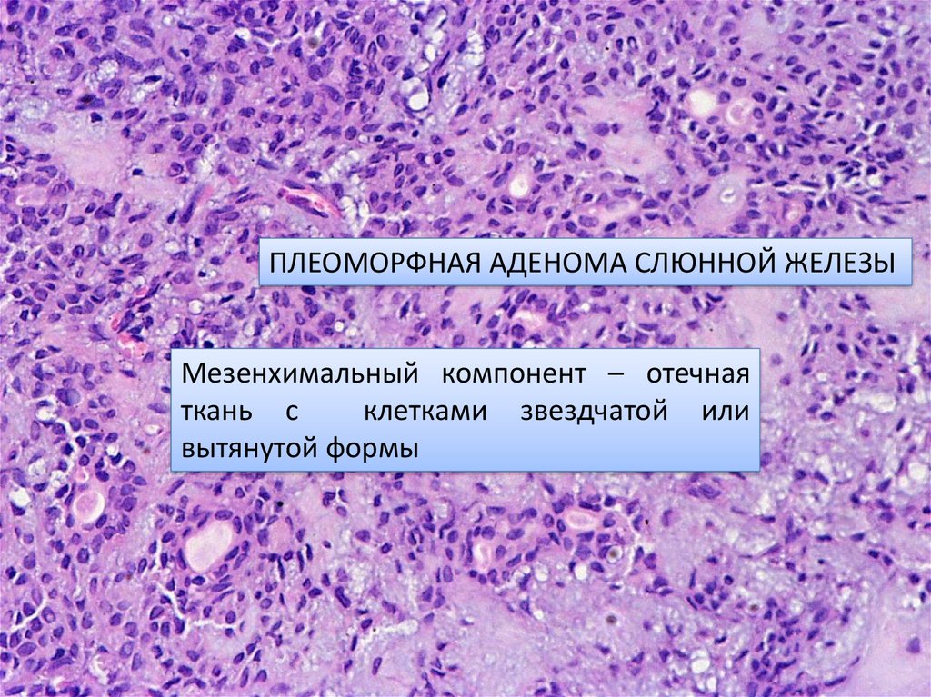 Аденома железы. Плеоморфная аденома гистология. Полиморфная аденома слюнной железы. Плеоморфная аденома слюнной железы гистология. Плеоморфной аденомы подчелюстной.