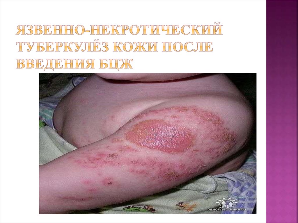 Язвенно-некротический туберкулёз кожи после введения БЦЖ