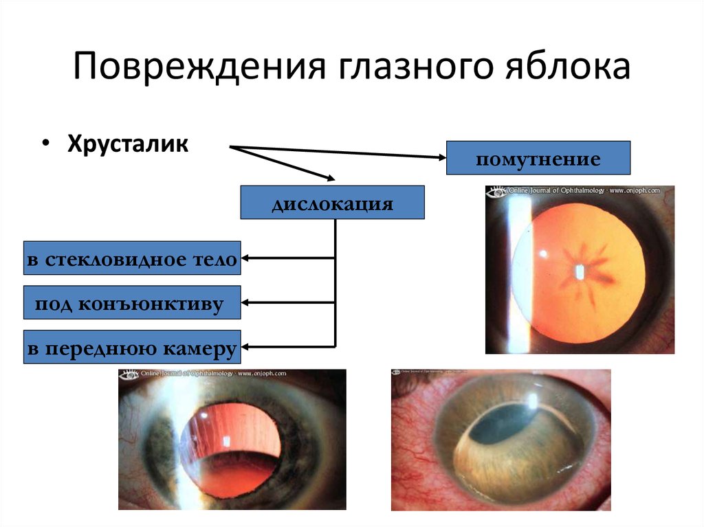 Есть видимые повреждения. Ранения глазного яблока классификация. Механическая травма глаза. Контузия глазного яблока.