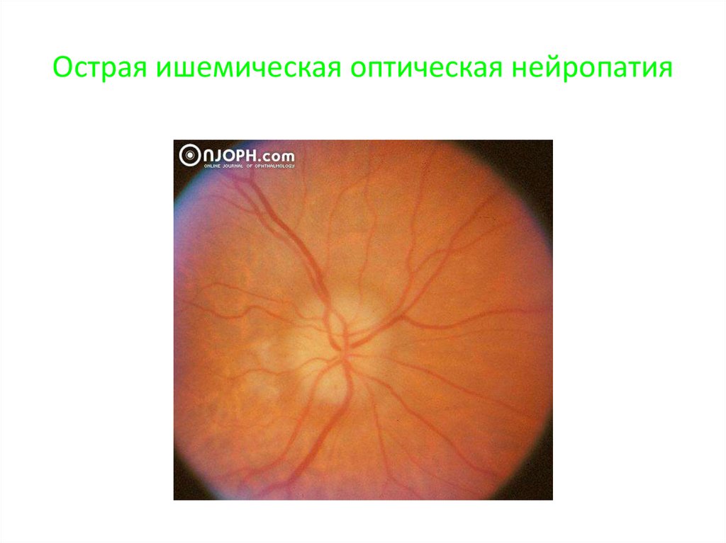 Нейропатия глаза. Ишемическая нейропатия глазное дно. Задняя ишемическая нейропатия зрительного нерва. Оптическая нейропатия глаза. Оптическая нейропатия зрительного нерва.