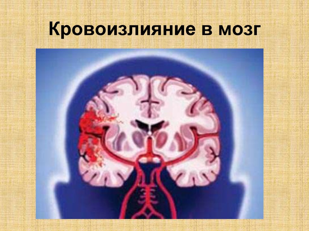 Кровоизлияние ствола мозга. Кровоизлияние в головной мозг. Кровоизлияния кровоизлияния в мозг. Внутреннее кровотечение мозга.
