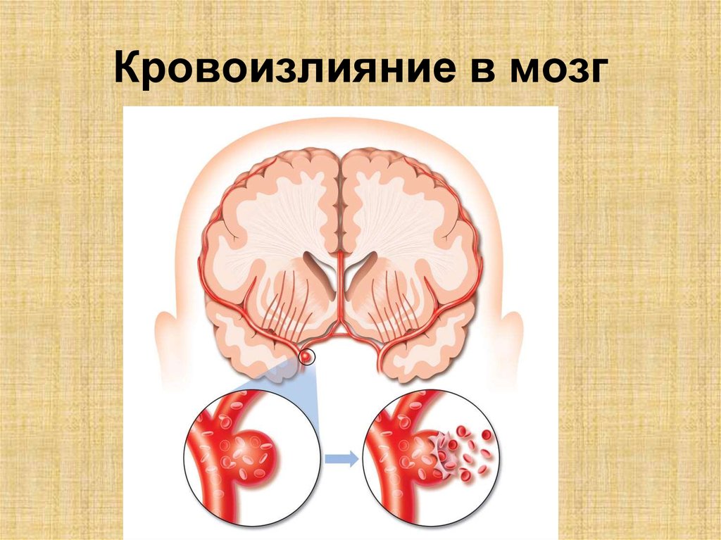 Травматическое кровоизлияние. Кровоизлияние в головной мозг. Субарахноидальное кровоизлияние в мозг. Внутреннее мозговое кровоизлияние.