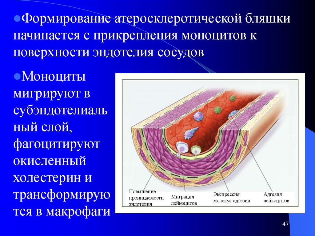 Склеротические бляшки. Атеросклеротическая бляшка. Формирование атеросклеротической бляшки. Эндотелий сосудов.