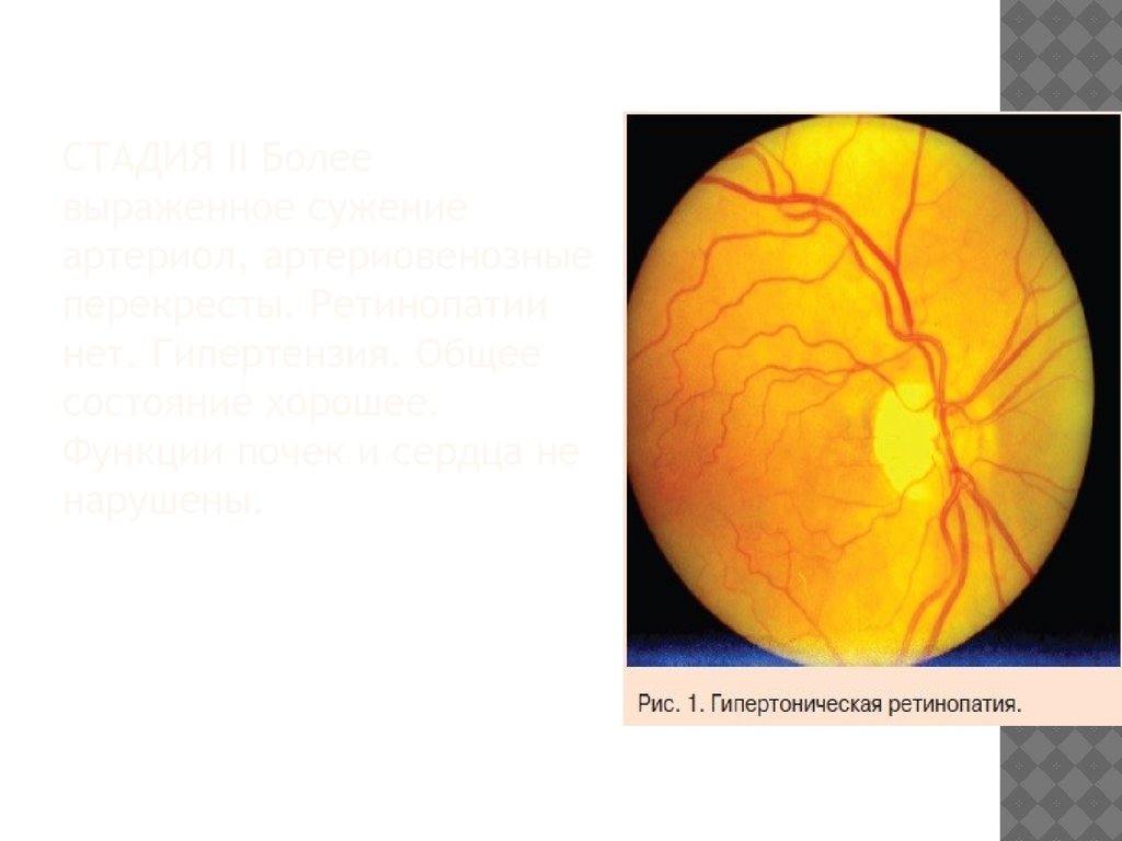Гипертоническая ретинопатия презентация