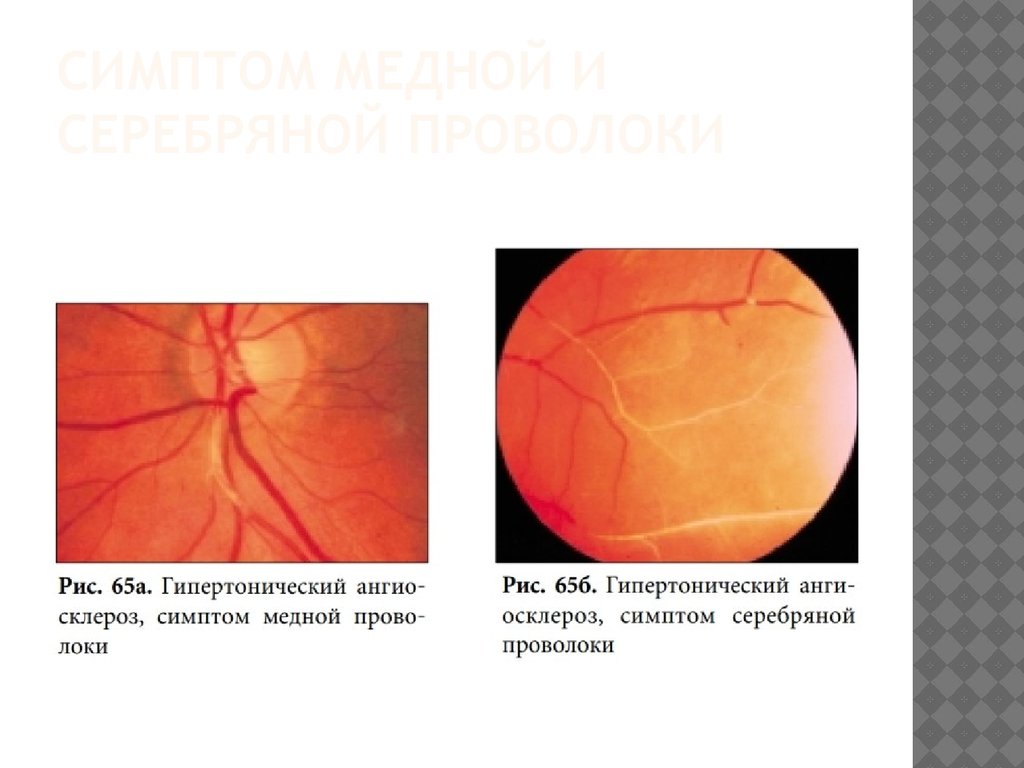 Гипертоническая ретинопатия презентация