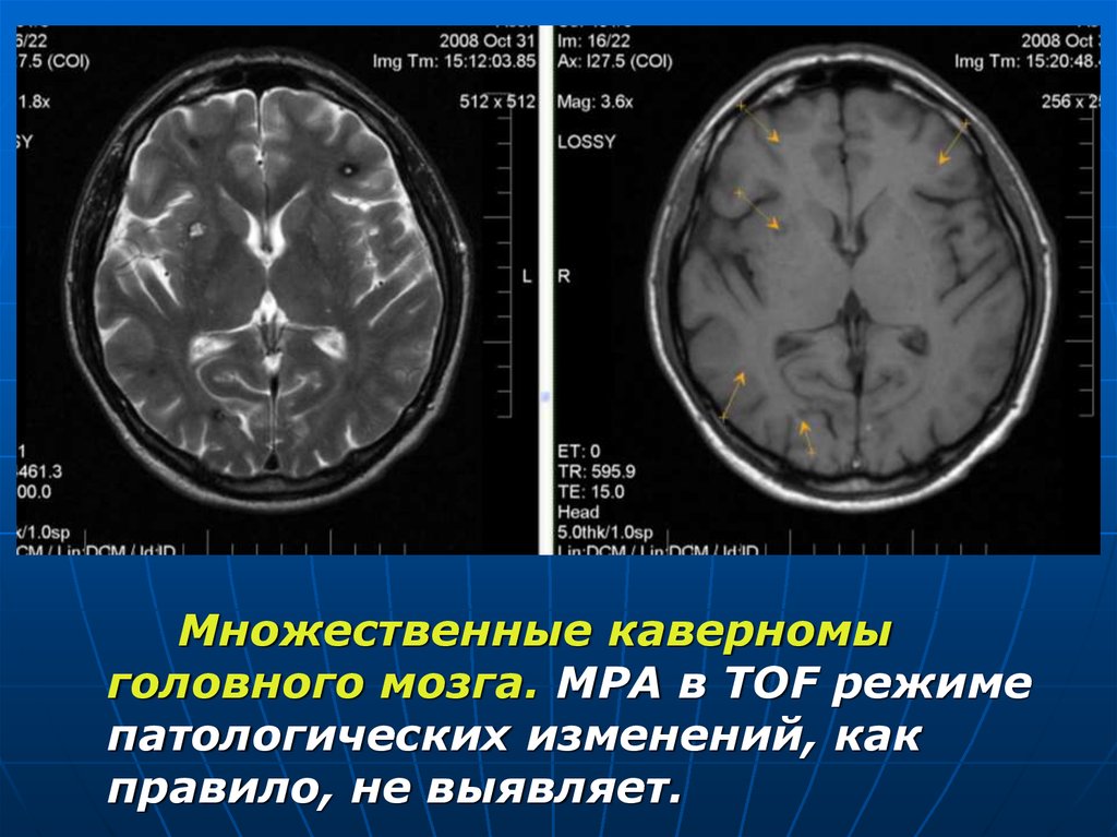 Ангиома правой лобной. Кавернозная гемангиома мозга кт. Ангиома головного мозга кт. Множественные каверномы головного мозга.