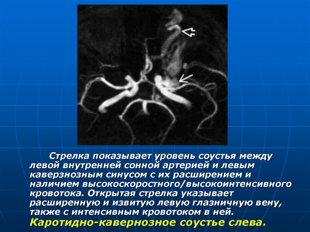 Каротидно феморальная спв. Каротидно-кавернозное соустье анатомия. Каротидно-кавернозное соустье слева. Извитой ход основной артерии. Кт ангиография презентация.