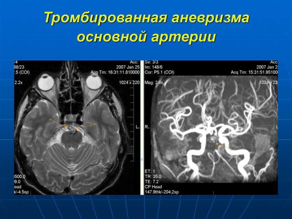 Мра артерий. Аневризма мозговых артерий кт. Кт-ангиография сосудов головы аневризма. Аневризма основной артерии на кт. Аневризма передней мозговой артерии мрт.