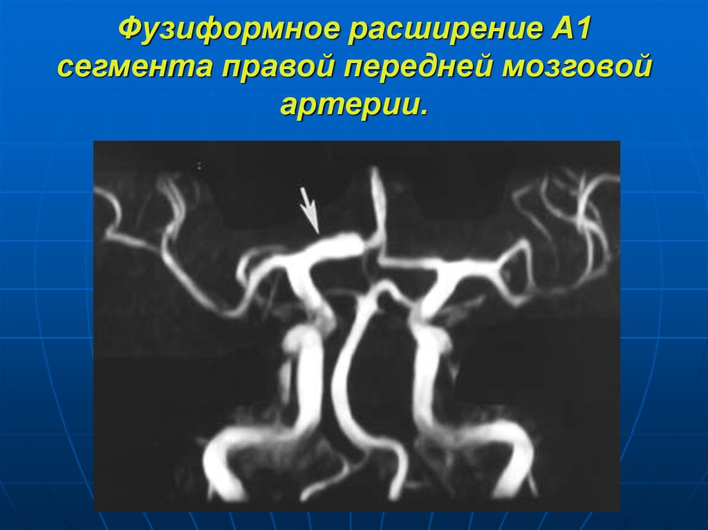 А1 сегменту правой передней мозговой артерии