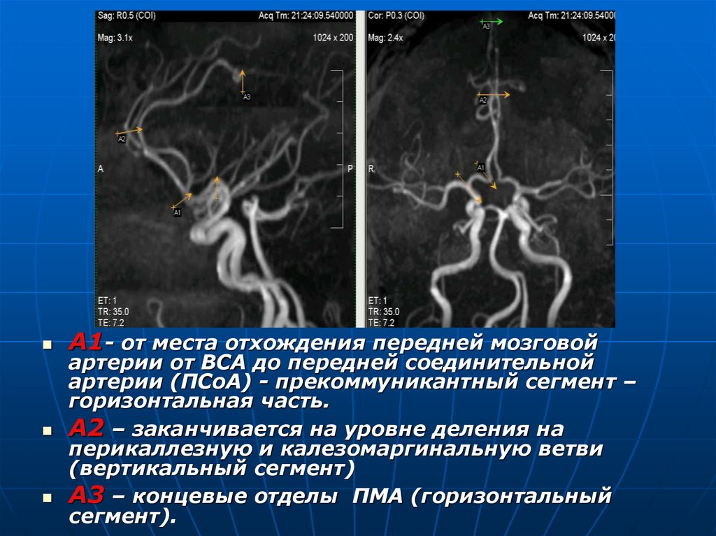 Сегмент а1 пма. Сегменты средней мозговой артерии на кт. Сегменты внутренней сонной артерии схема кт. Гипоплазия а1 сегмента правой передней мозговой артерии кт. Сегменты средней мозговой артерии схема.