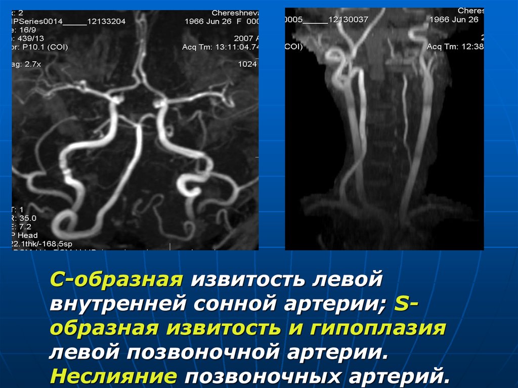 Изгиб вса. Гипоплазия позвоночной артерии на УЗИ. S образная извитость левой внутренней сонной артерии. Извитость внутренней сонной артерии мрт. Патологическая извитость артерий (кинкинг).