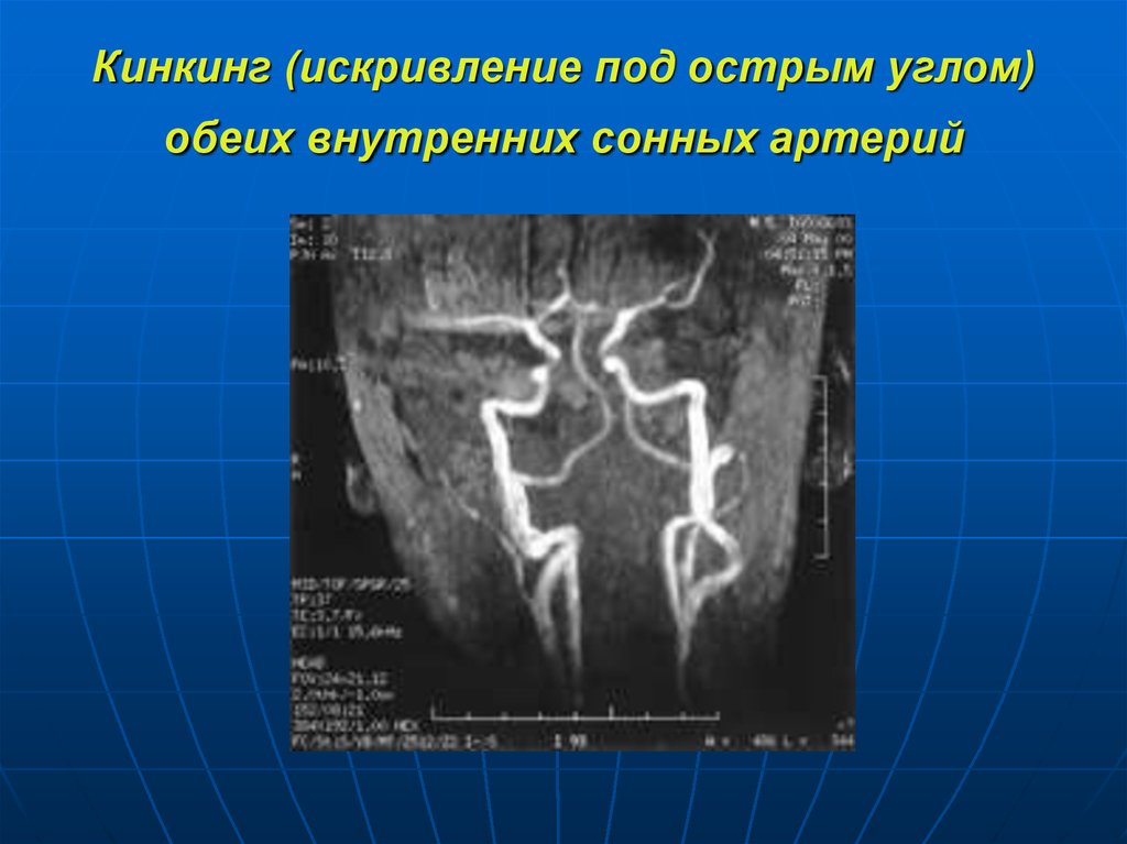 S извитость сонной артерии