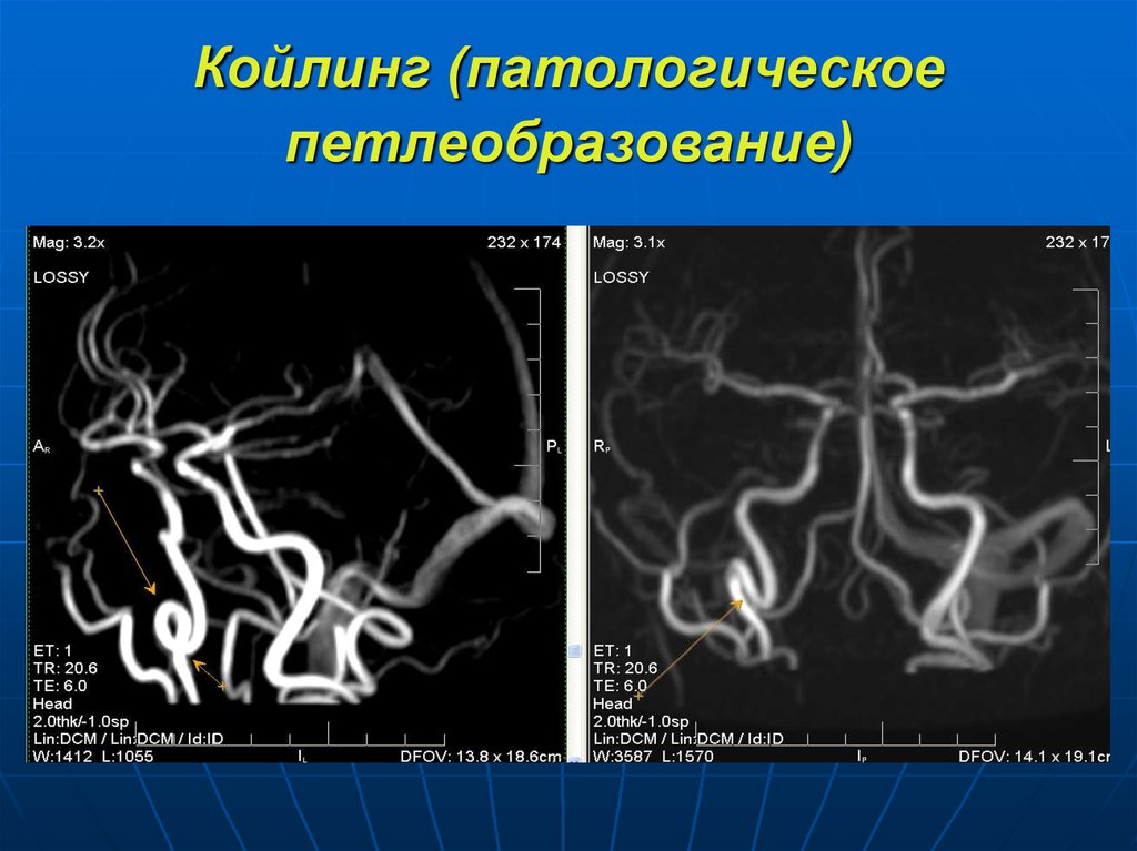 Изгиб вса. Кинкинг и койлинг внутренней сонной артерии. Койлинг позвоночных артерий. Патологическая извитость внутренней сонной артерии. Патологическая извитость сонных артерий койлинг.