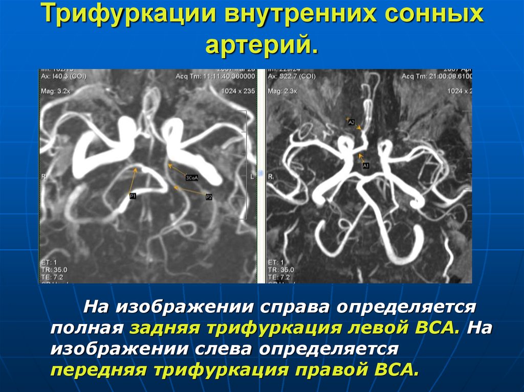 Виллизиев круг вариант развития на мрт. Виллизиев круг в головном мозге. Трифуркация задней мозговой артерии. Задняя трифуркация правой и левой внутренних сонных артерий. Трифуркация правой передней мозговой артерии.