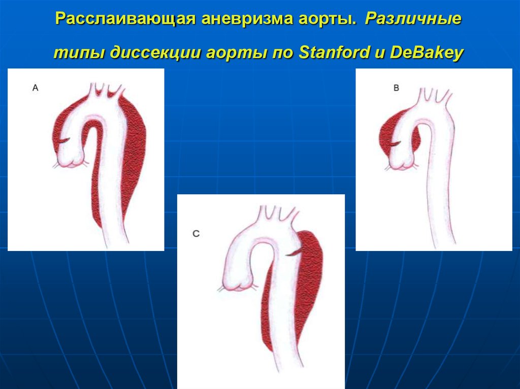Расслаивающая аневризма аорты. Расслаивающая аневризма аорты Дебейки. Расслаивающая аневризма аорты 3 типа. Типы расслаивающей аневризмы аорты по Дебейки. Расслаивающая аневризма аорты 2 Тип.