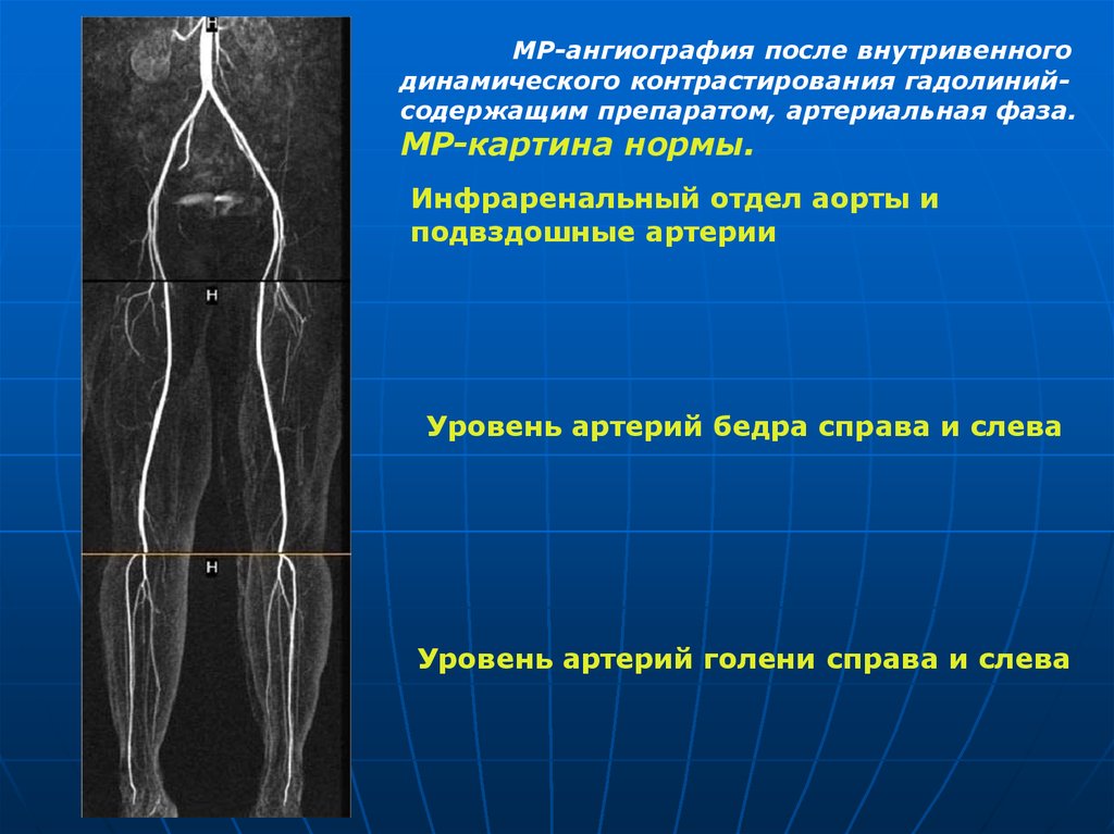 Окклюзионная артерия