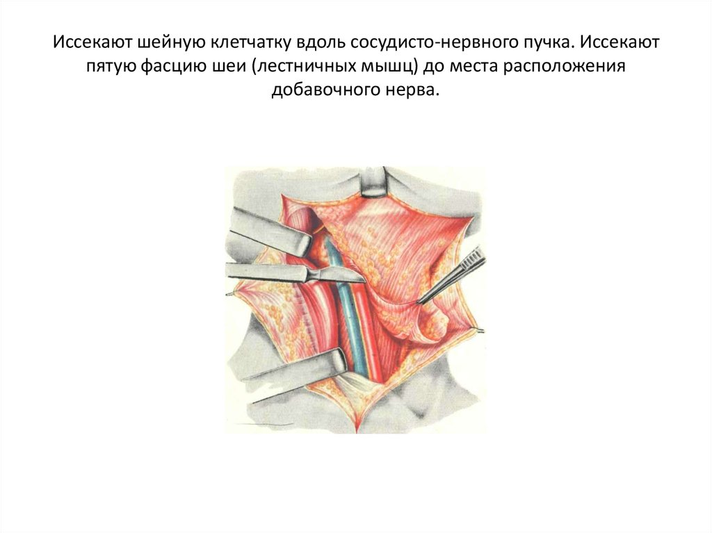 Латеральный пучок шеи