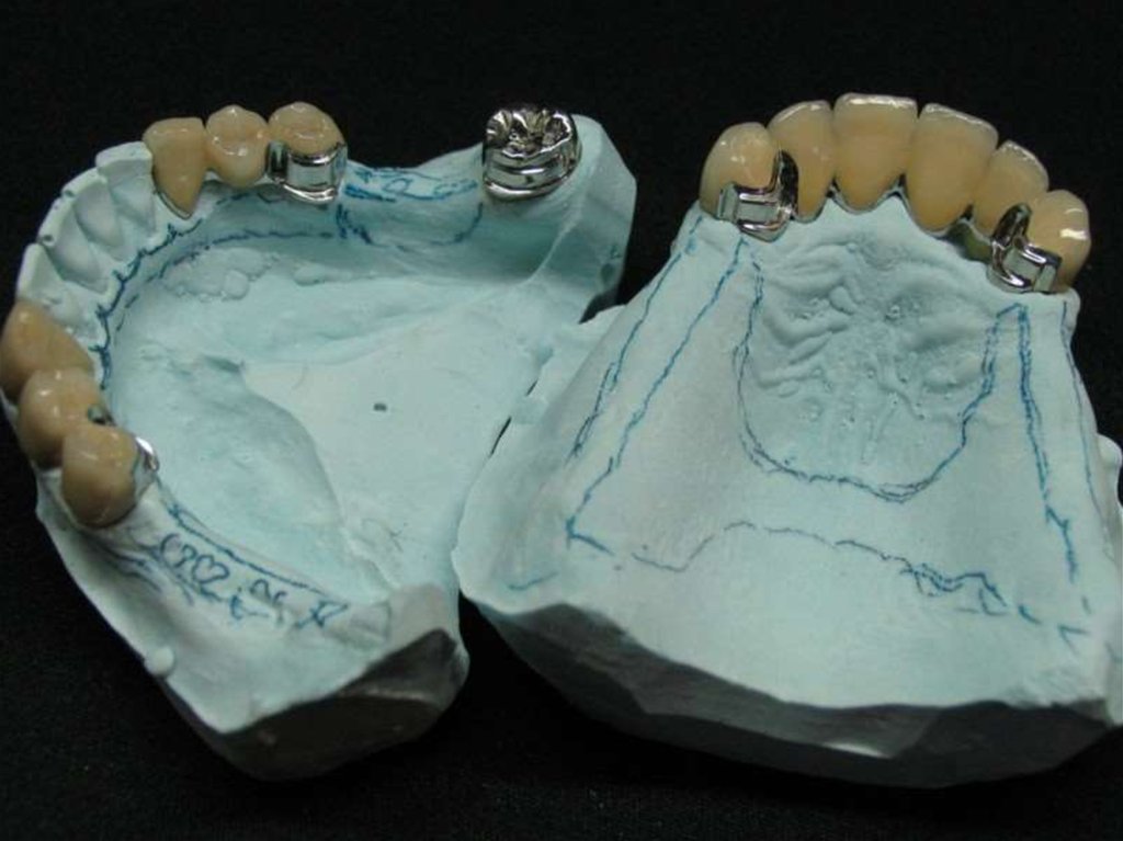 Патология твердых тканей. Аномалии структуры твердых тканей зубов. Поделки патологии.