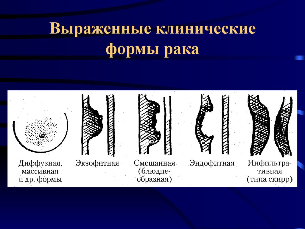 Эндофитный рост опухоли рисунок