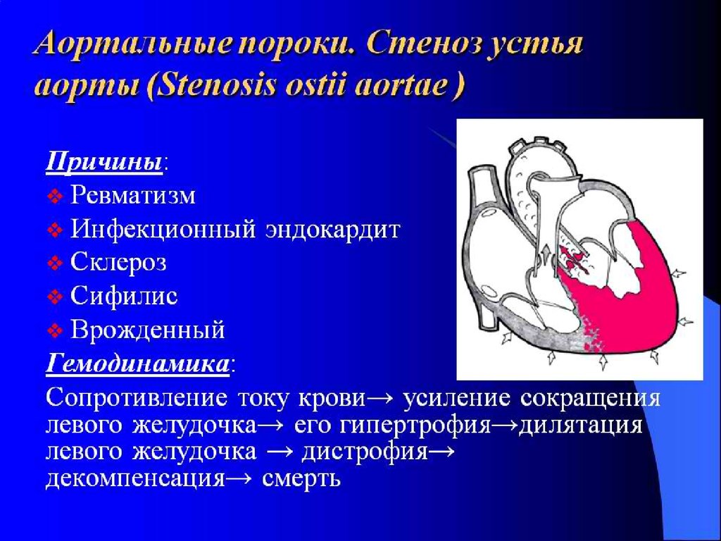 Почему сердечный. Аортальный стеноз и недостаточность. Порок сердца стеноз аортального клапана. Аортальная недостаточность врожденный порок. Клинические проявления при стенозе устья аорты.