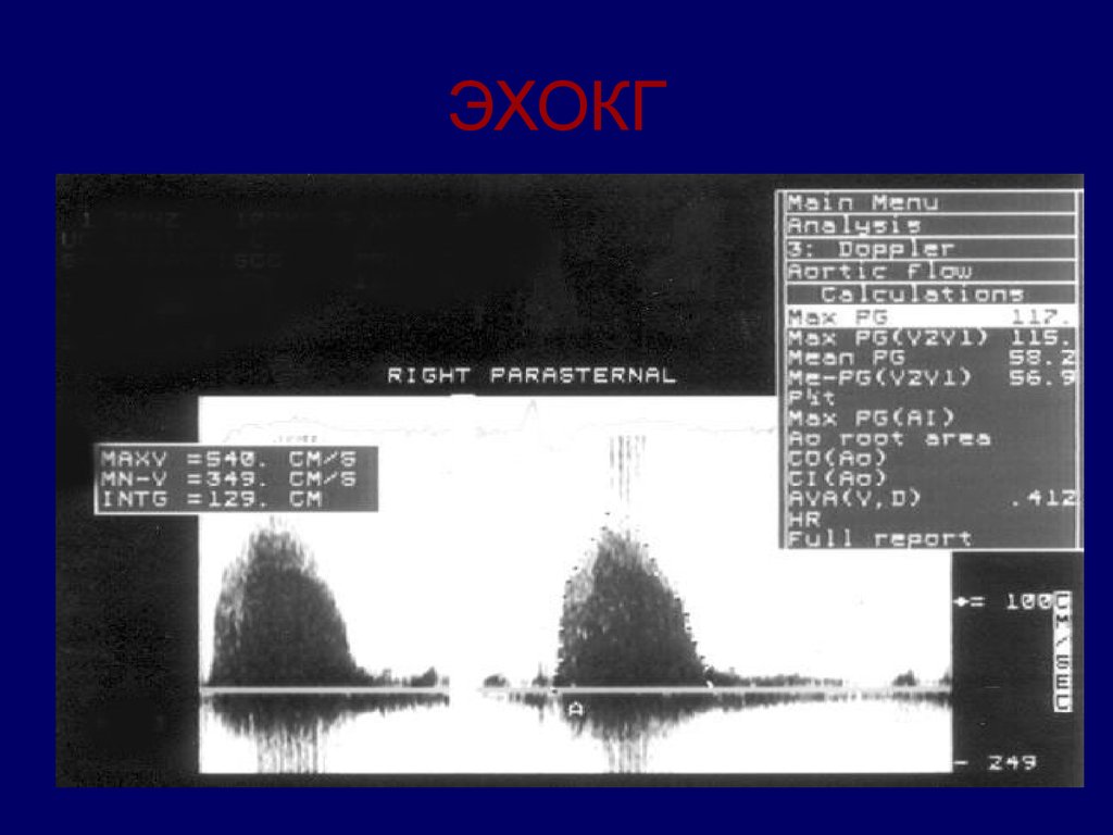 ЭХОКГ