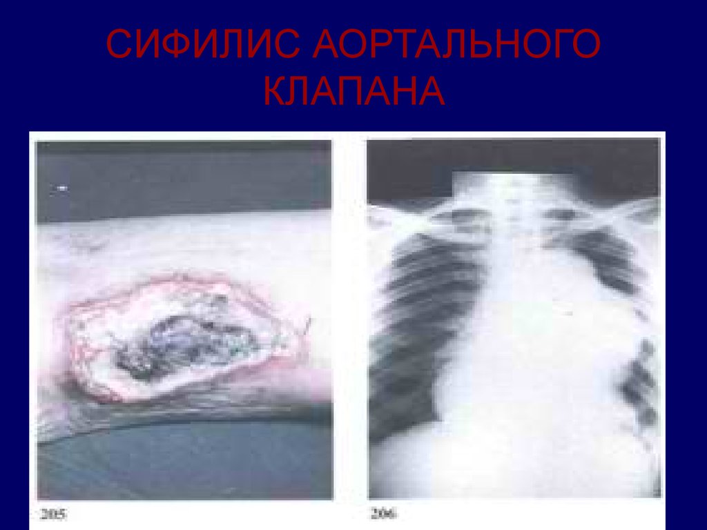 СИФИЛИС АОРТАЛЬНОГО КЛАПАНА
