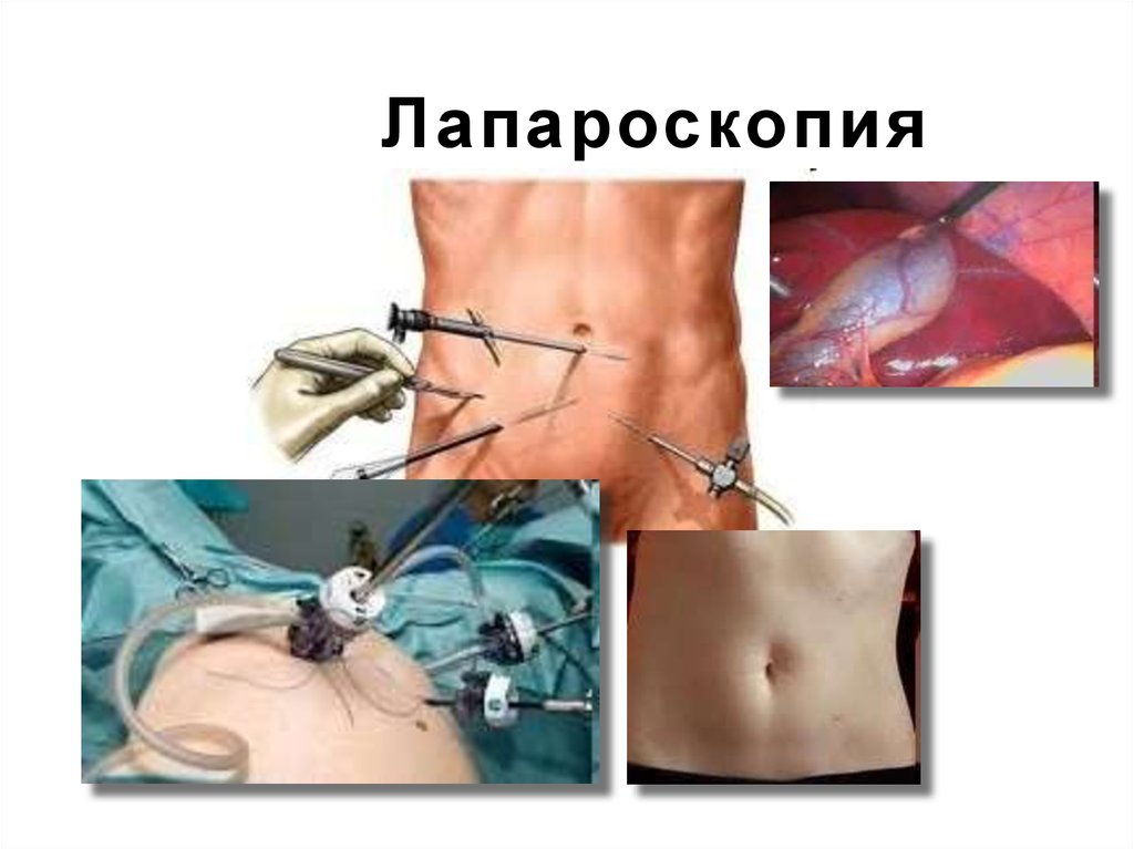 Лапароскопия