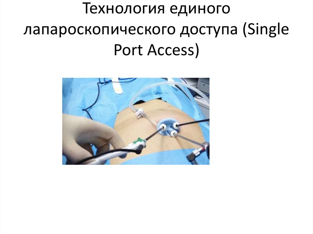 Технология единого лапароскопического доступа (Single Port Access)