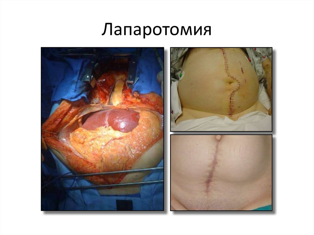 Лапаротомия
