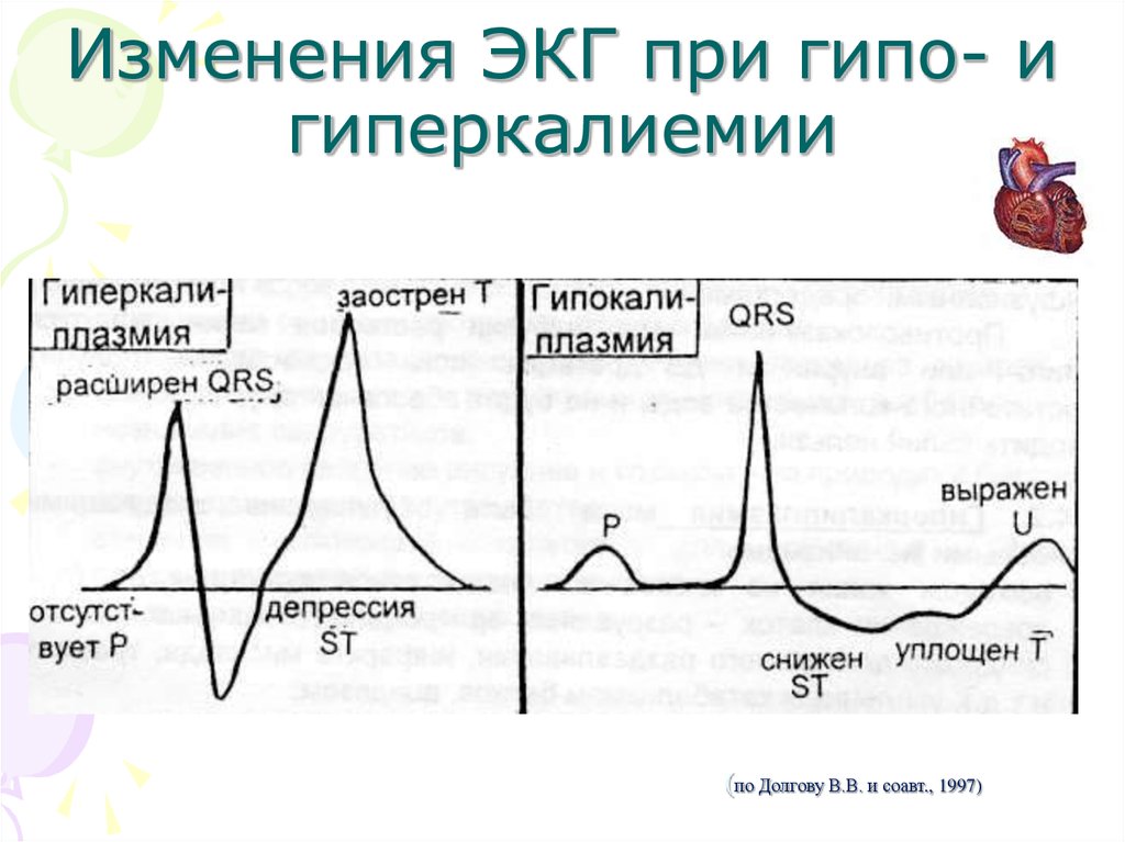 Гиперкалиемия на экг картинки