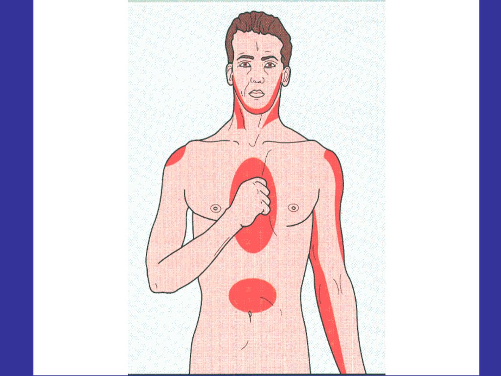Иррадиация при стенокардии. Локализация боли при ИБС. Локализация боли при инфаркте миокарда.