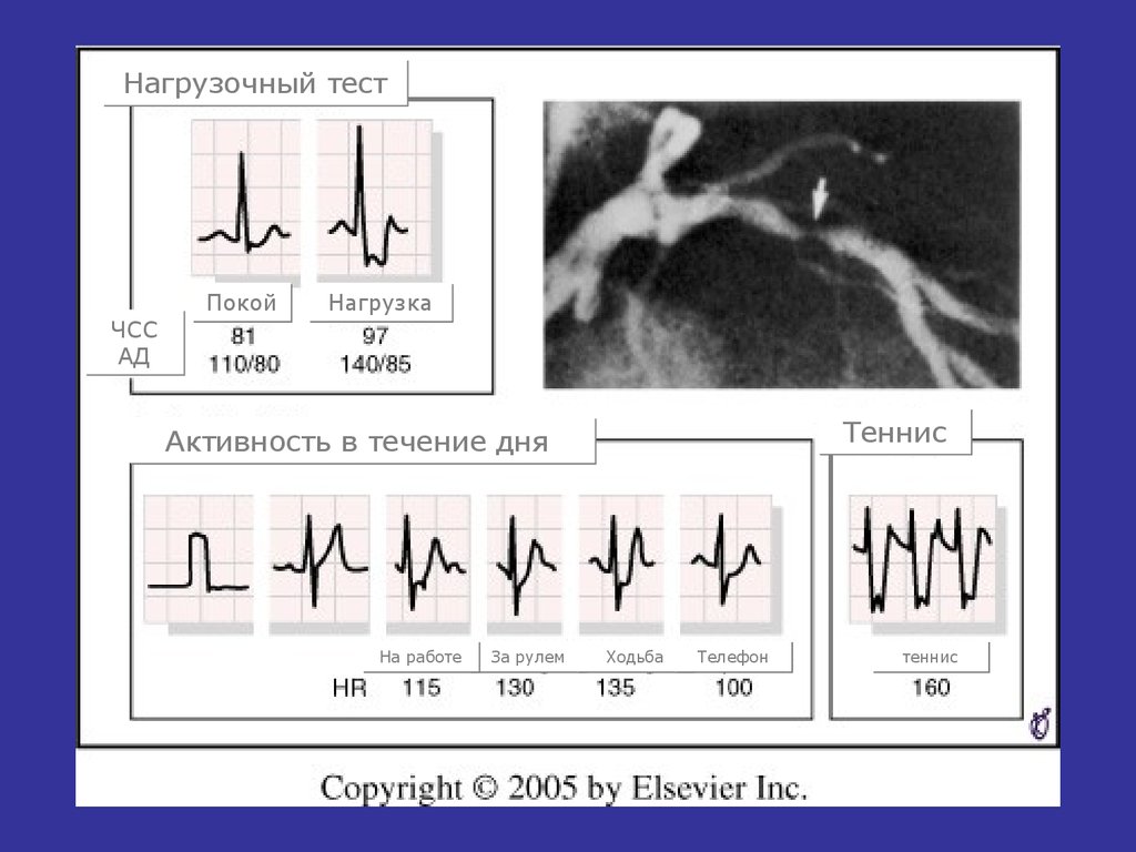 Тест на активность. ЧСС при ишемической болезни. Стенокардия ЧСС. ЧСС при стенокардии. Нагрузочные тесты при ИБС.