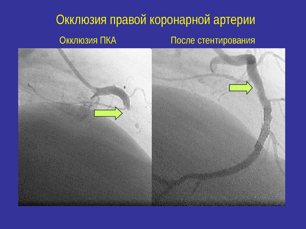 Окклюзия справа. Окклюзия коронарной артерии на коронарографии. Инфаркт миокарда коронарография. Хроническая окклюзия коронарных артерий. Тромботическая окклюзия коронарной артерии.