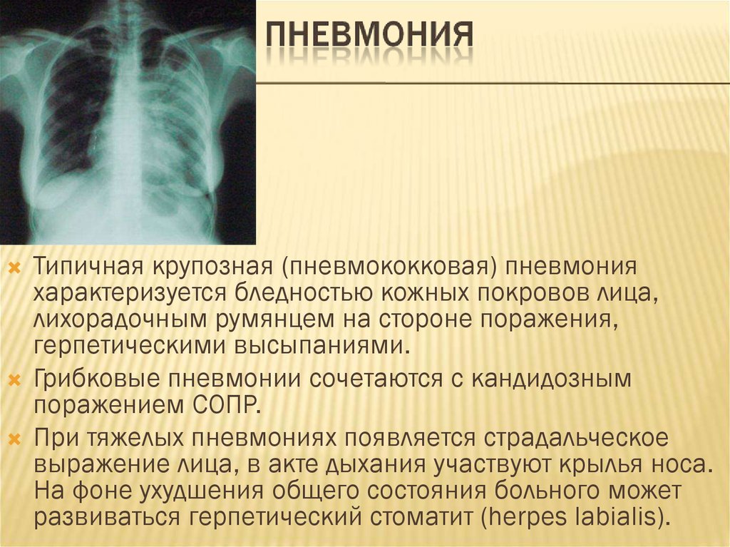 Пневмония это что за болезнь. Пневмококковая пневмония крупозная. При крупозной пневмонии. Крупозная пневмония характеризуется.