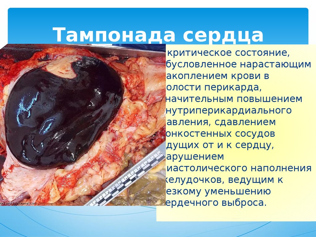 Тампонада сердца