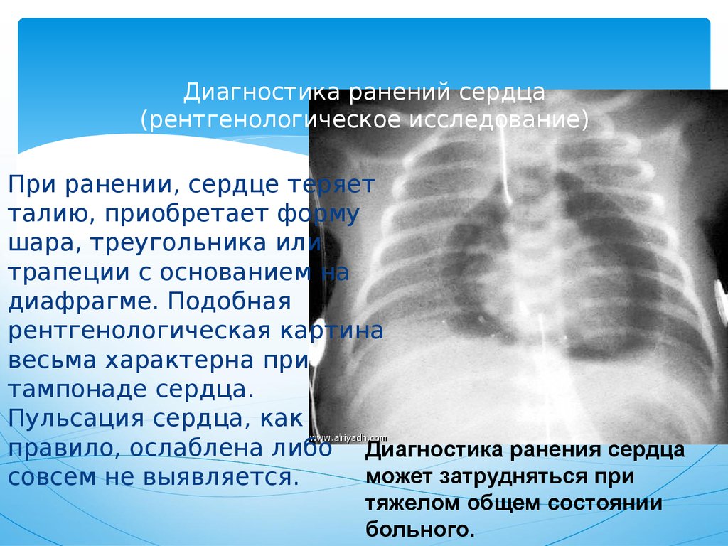 Закрытая травма сердца презентация