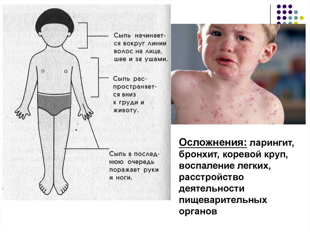 Инфекционные заболевания у детей фото