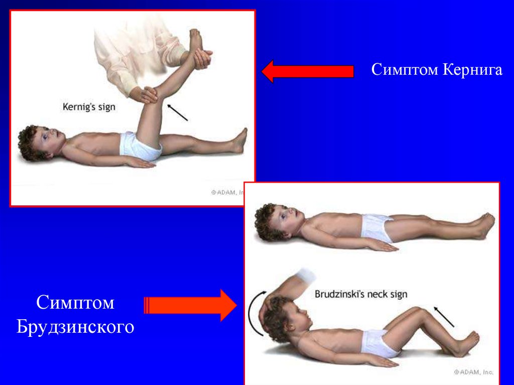 Симптом кернига. Менингеальные симптомы Кернига и Брудзинского. Симптом Кернига и Брудзинского. Симптомы менингита Кернига Брудзинского. Кернига Брудзинского Лесажа.