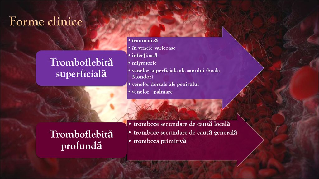tratamentul venelor varicoase tromboflebit varicoza perfuzie