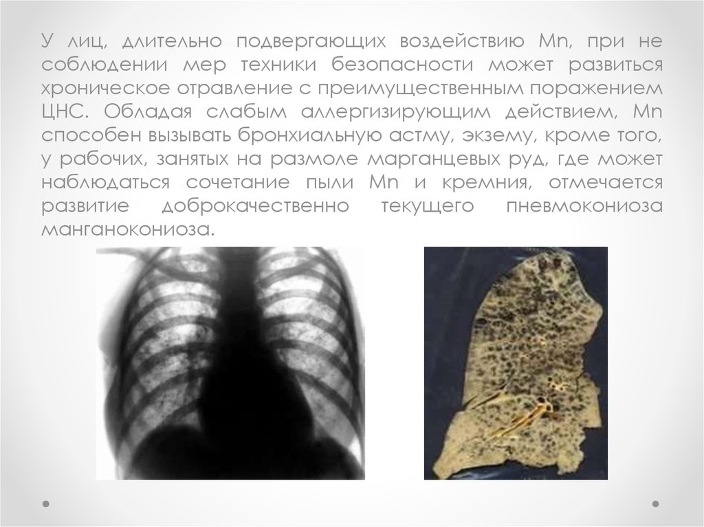 Марганцевая интоксикация. Патогенез марганцевой интоксикации. Хроническая марганцевая интоксикация. Отравление марганцем. Хроническое отравление марганцем презентация.