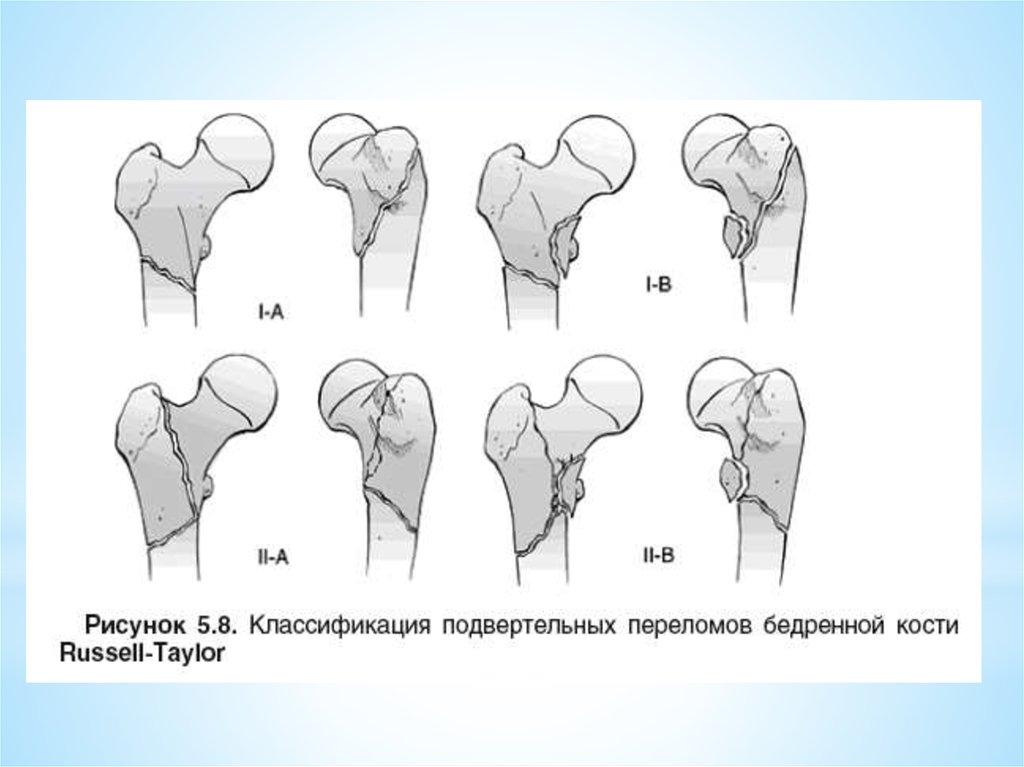 Перелом шейки бедра карта вызова