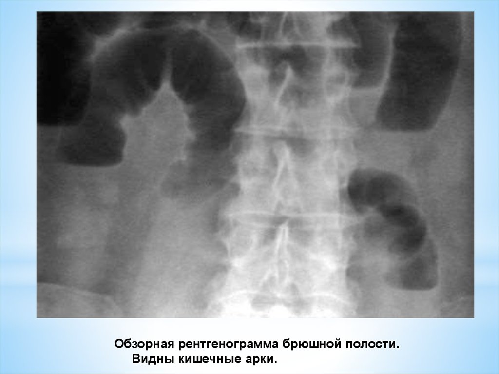 Рентгенография органов брюшной полости. Обзорная рентгенография брюшной полости кишечная непроходимость. Инвагинация кишечника на обзорной рентгенографии. Спаечная кишечная непроходимость рентген. Кишечная непроходимость обзорная рентгенография.