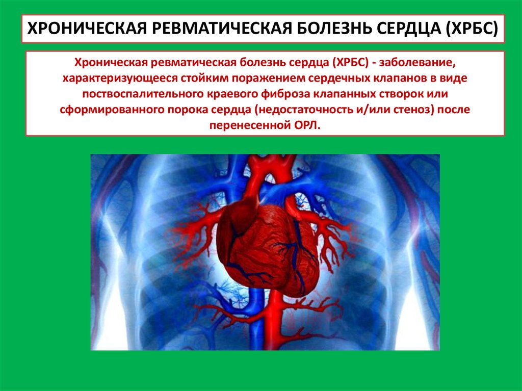 Стойкое поражение. Хроническая ревматическая болезнь сердца. Хроническая ревматическая болезнь сердца синдромы. Ревматическая болезнь сердца клинические проявления.