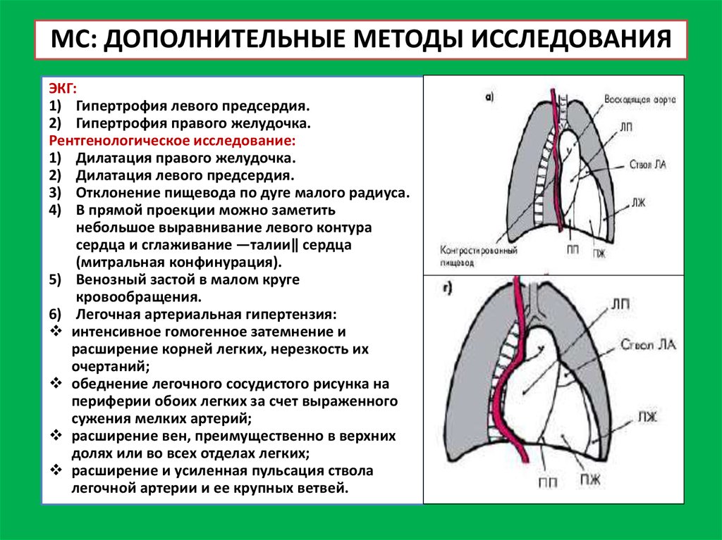 Расширение предсердий