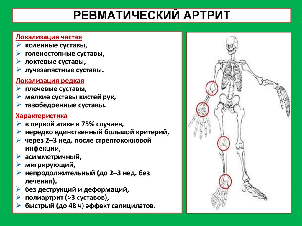 Ревматизм и ревматоидный артрит. Ревматический артрит локализация. Ревматический артрит и ревматоидный артрит. Изменение суставов при ревматизме характеризуются.