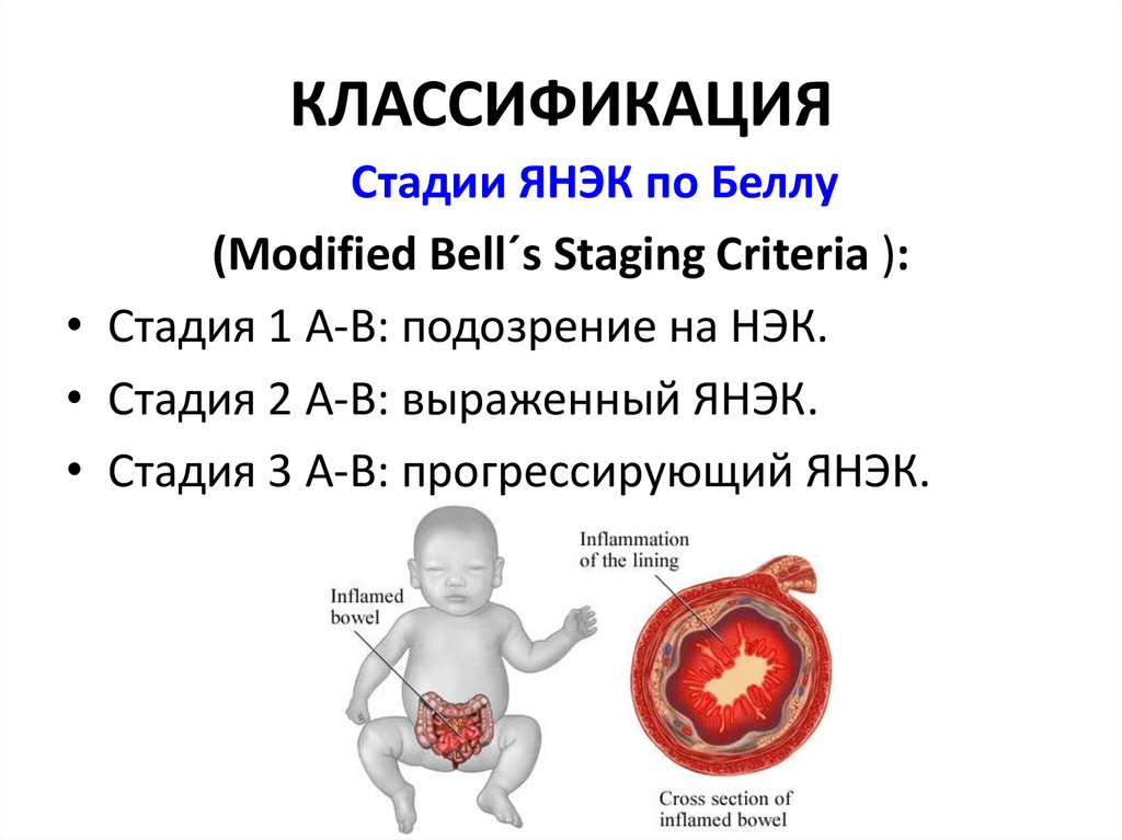 Нэк у новорожденных презентация