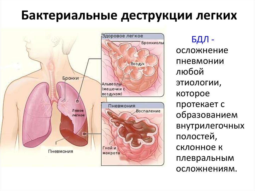 Бактериальная деструкция легких у детей презентация