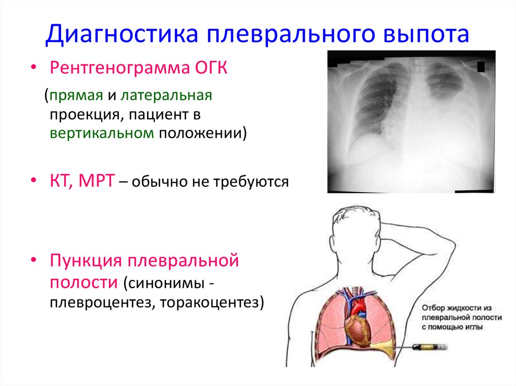 Жидкость в плевральной полости. Минимальный выпот в плевральной полости. Синдром плеврального выпота. Признаки выпота в плевральной полости.